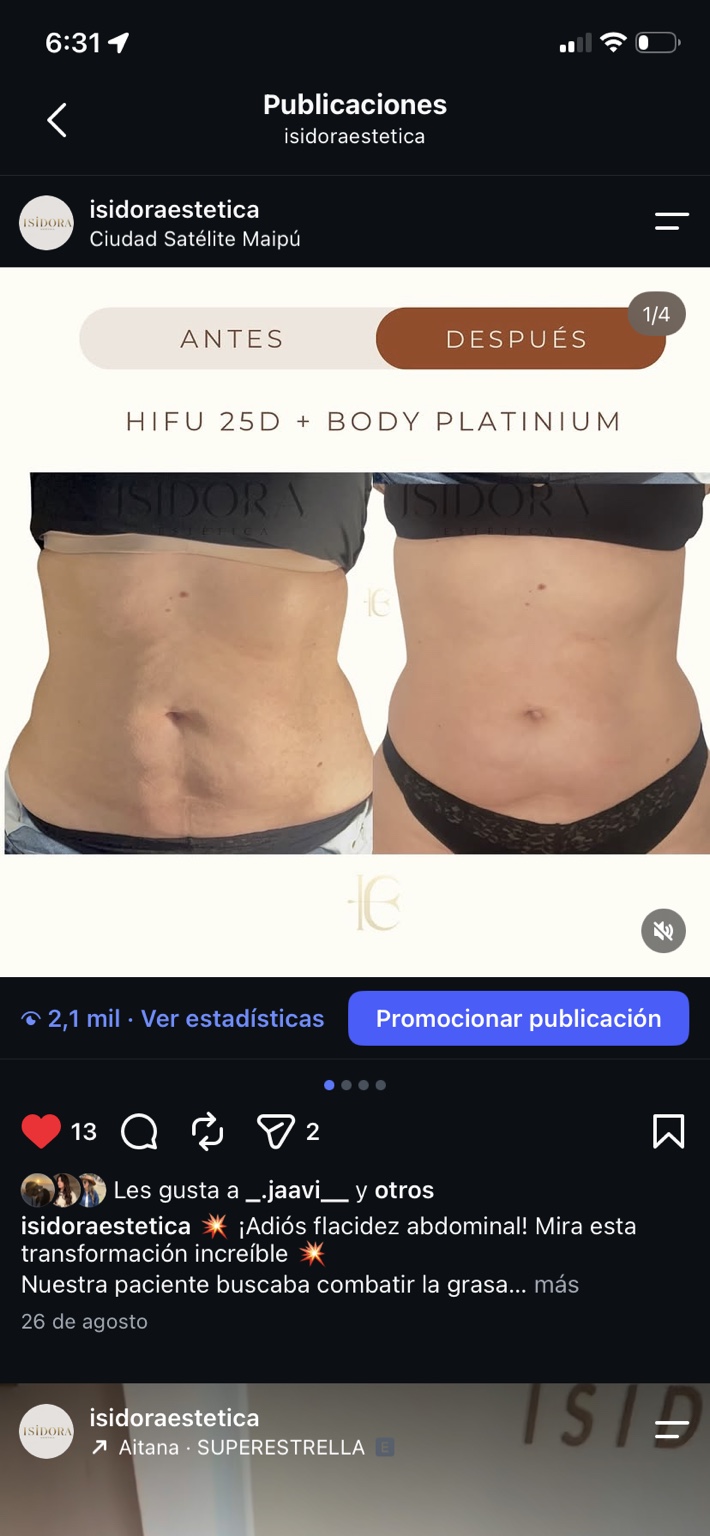 Comparación de antes y después de HIFU 25D y Body Platinium en abdomen.